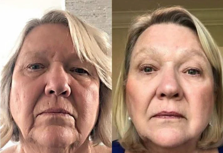 S8 Microneedling Pen +30 Cartridges & Serum Free - Limited Time Offer