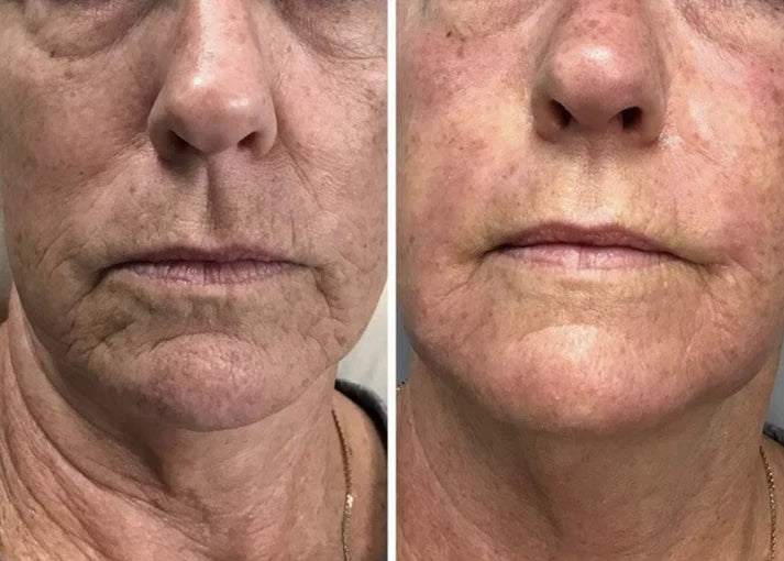 S8 Microneedling Pen +30 Cartridges & Serum Free - Limited Time Offer