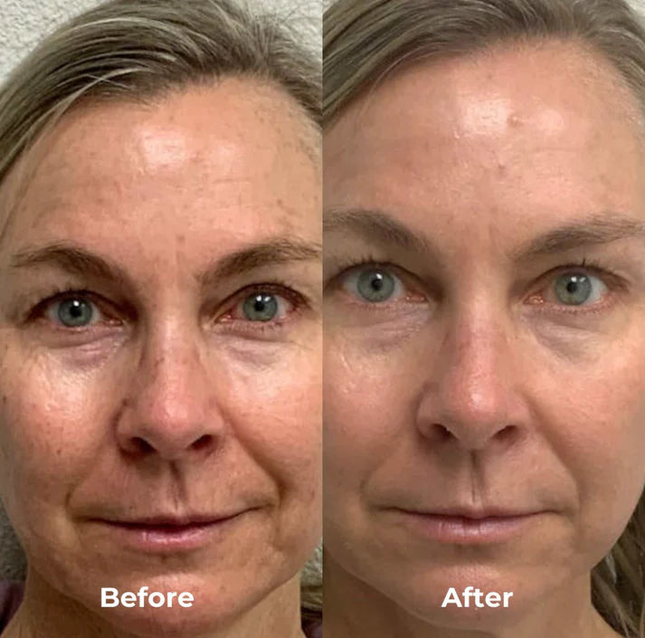 S8 Microneedling Pen +30 Cartridges & Serum Free - Limited Time Offer