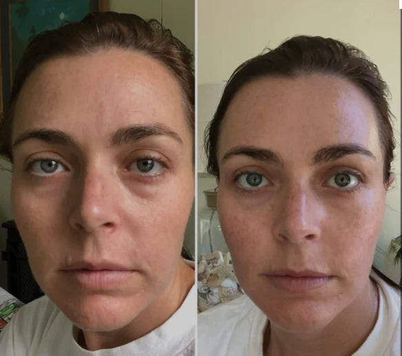 S8 Microneedling Pen +30 Cartridges & Serum Free - Limited Time Offer