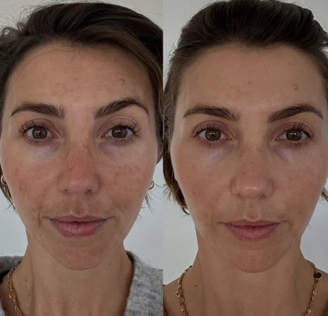 S8 Microneedling Pen +30 Cartridges & Serum Free - Limited Time Offer